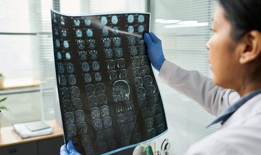 I ricercatori utilizzano la tecnologia in stile ChatGPT per prevedere il rischio di ictus dal DNA di una persona Marta Iraola Iribarren
